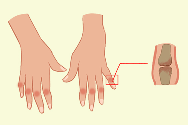 �ϻ�Ƥ�Ĺ�Ч�����ü�ʳ�÷��� �ϻ�Ƥ�Ĺ�Ч������